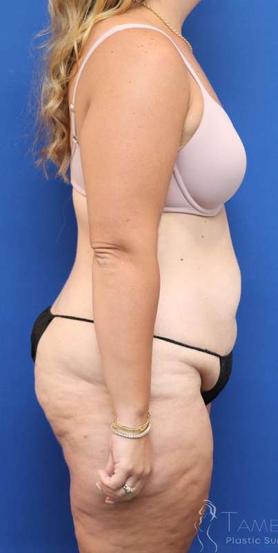 Tummy Tuck Before & After Patient #1343