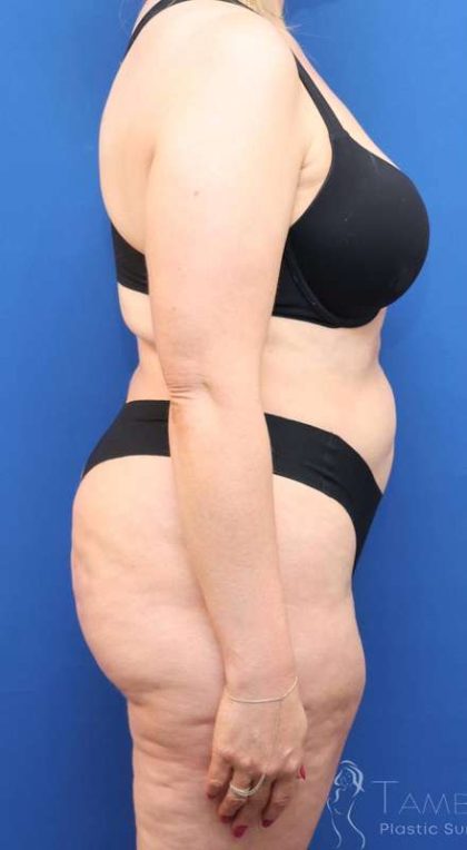 Tummy Tuck Before & After Patient #1356