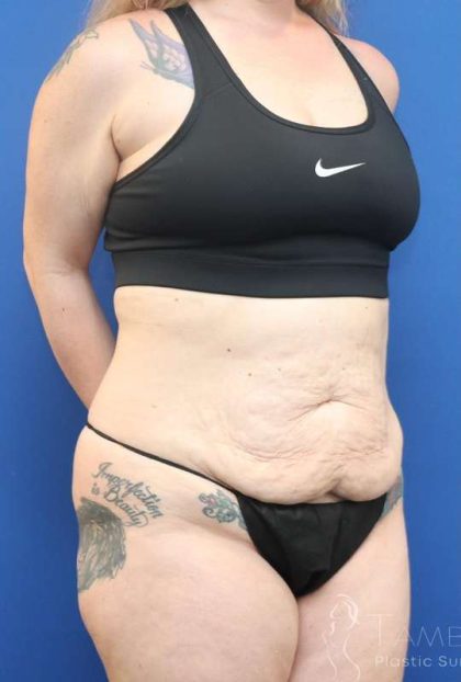 Tummy Tuck Before & After Patient #1369