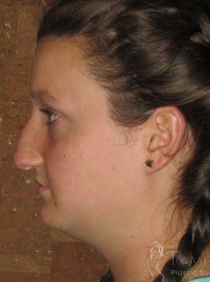 Rhinoplasty Before & After Patient #1406