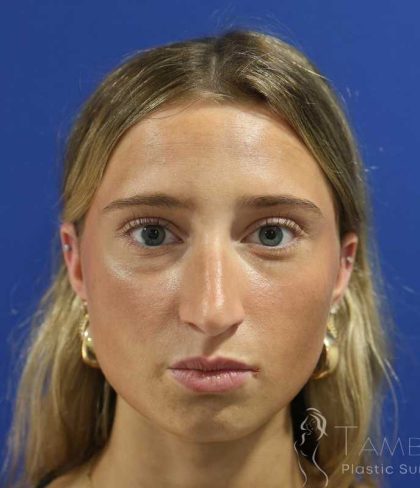 Rhinoplasty Before & After Patient #1415