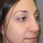 Rhinoplasty Before & After Patient #1424