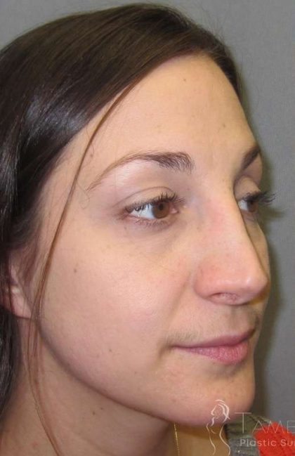 Rhinoplasty Before & After Patient #1424