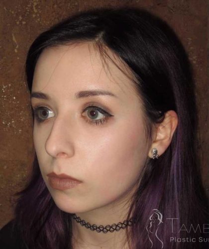 Rhinoplasty Before & After Patient #1439