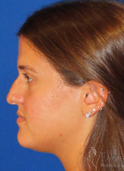 Rhinoplasty Before & After Patient #1454