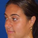 Rhinoplasty Before & After Patient #1465