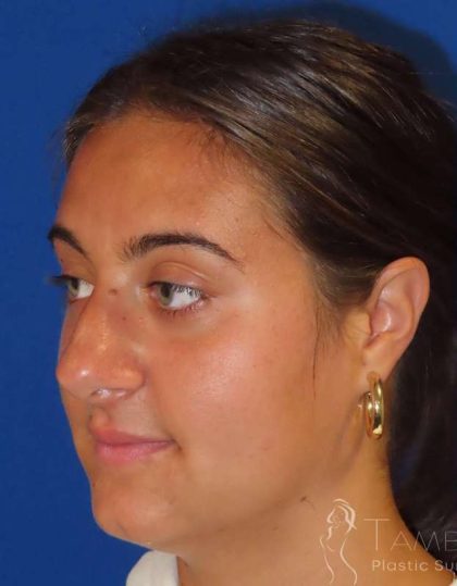 Rhinoplasty Before & After Patient #1465