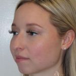 Rhinoplasty Before & After Patient #1476