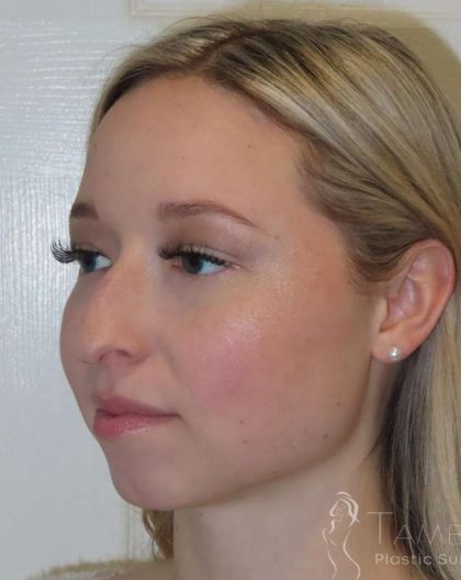 Rhinoplasty Before & After Patient #1476
