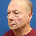 Neck Lift Before & After Patient #1487