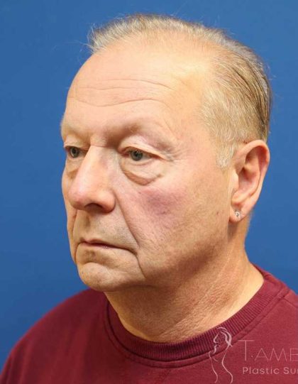 Neck Lift Before & After Patient #1487