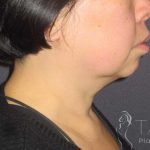 Neck Lift Before & After Patient #1498