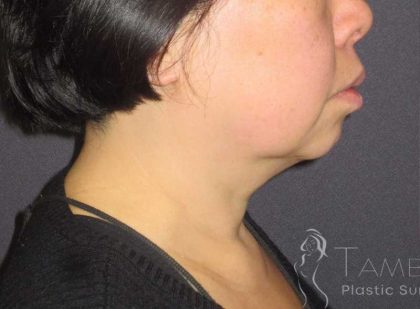 Neck Lift Before & After Patient #1498