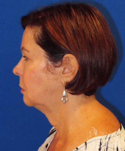 Neck Lift Before & After Patient #1578
