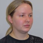 Neck Lift Before & After Patient #1589