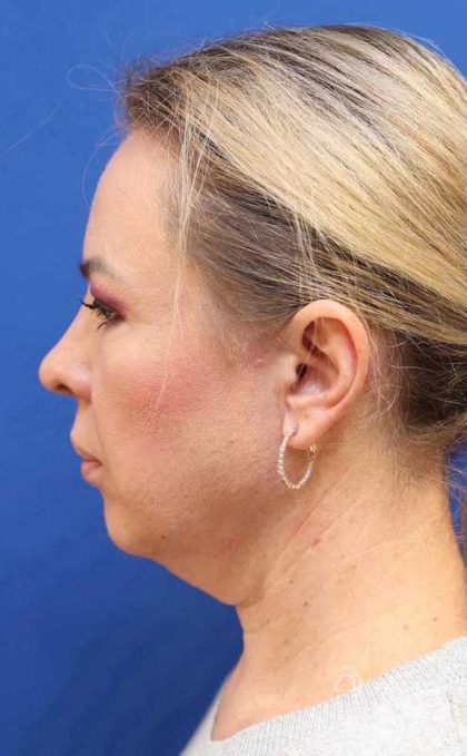 Facelift Before & After Patient #1609