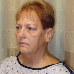 Facelift Before & After Patient #1620