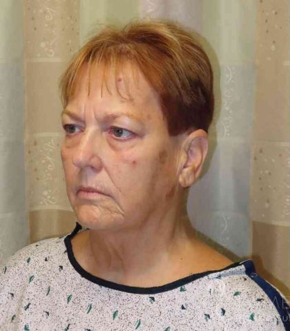 Facelift Before & After Patient #1620