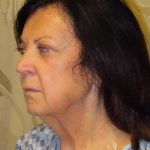Facelift Before & After Patient #1631