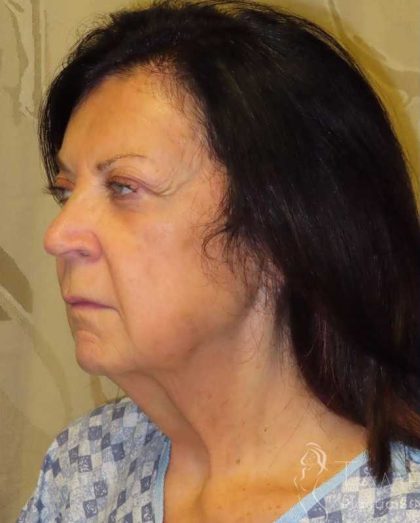 Facelift Before & After Patient #1631