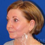 Facelift Before & After Patient #1642