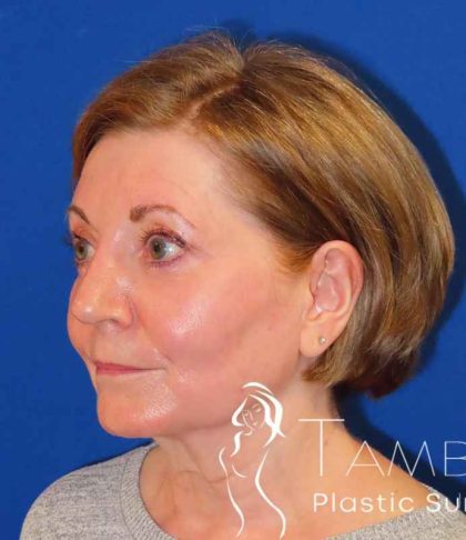 Facelift Before & After Patient #1642