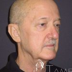 Facelift Before & After Patient #1675