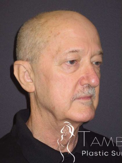 Facelift Before & After Patient #1675