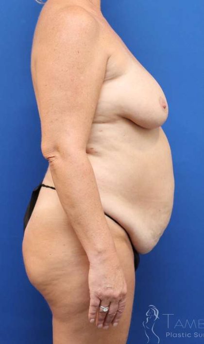 Mommy Makeover Before & After Patient #487