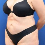 Lower Body Lift Before & After Patient #598