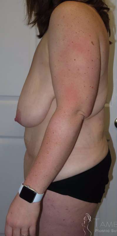Breast Lift Before & After Patient #1937
