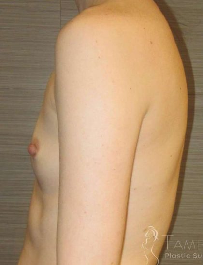 Breast Augmentation Before & After Patient #2081