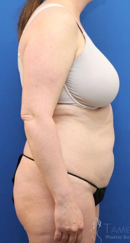 Liposuction Before & After Patient #641