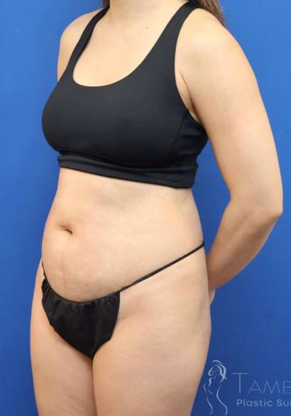 Liposuction Before & After Patient #668