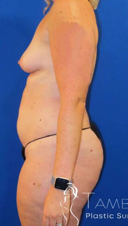 Liposuction Before & After Patient #702