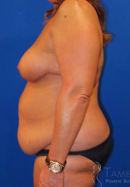 Liposuction Before & After Patient #777