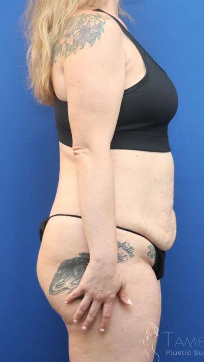 Liposuction Before & After Patient #852