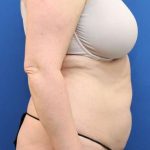 Brazilian Butt Lift Before & After Patient #906
