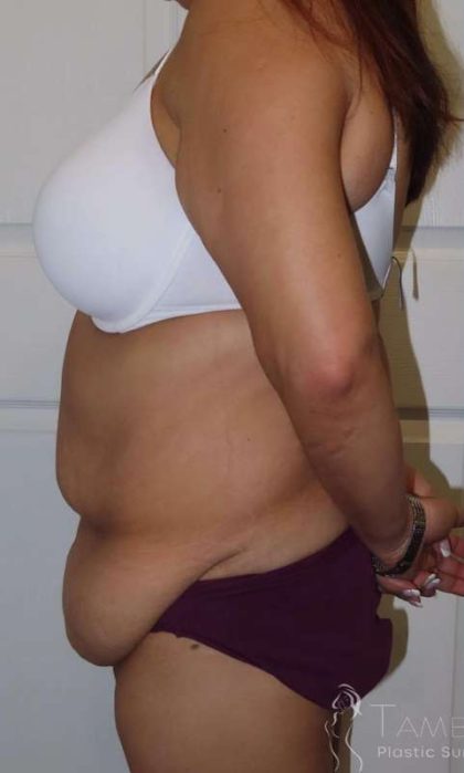 Body Contouring Before & After Patient #1038