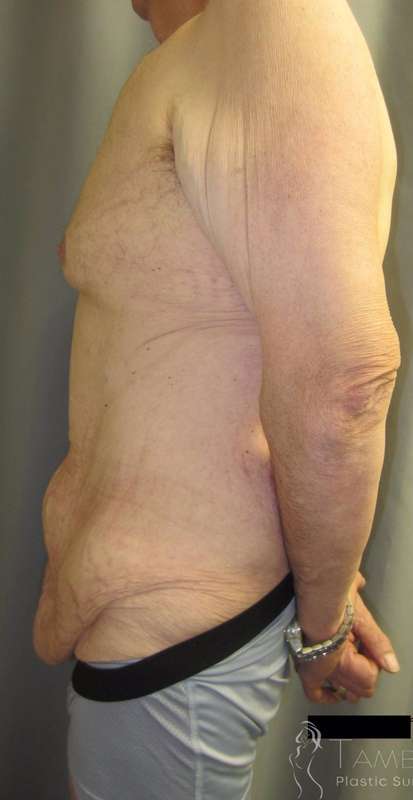 After Weight Loss Surgery Before & After Patient #1112