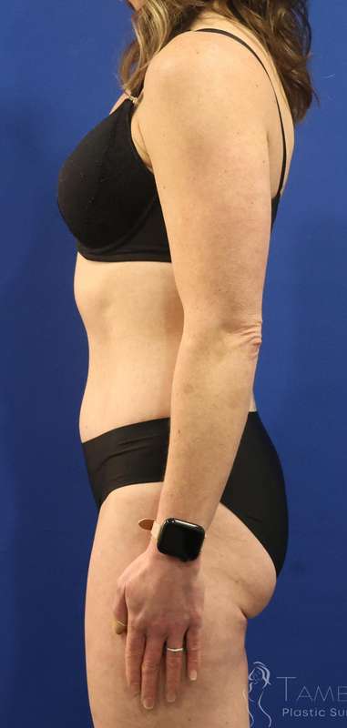 Tummy Tuck Before & After Patient #1153