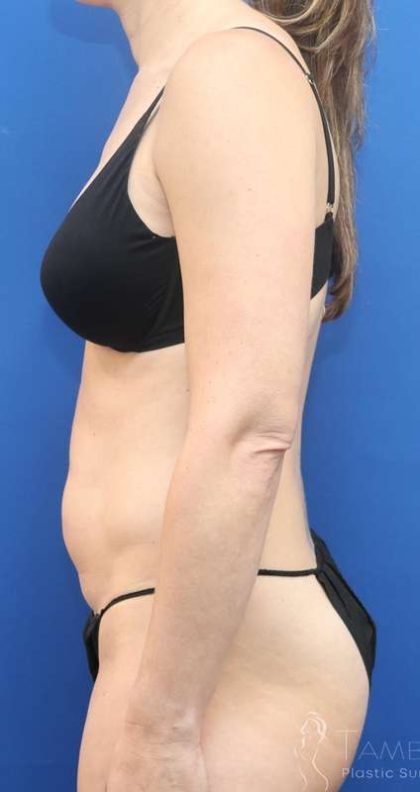 Tummy Tuck Before & After Patient #1164