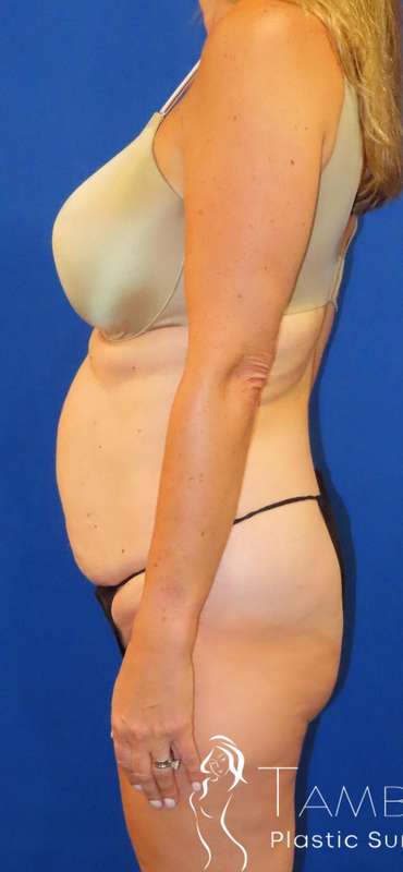 Tummy Tuck Before & After Patient #1190