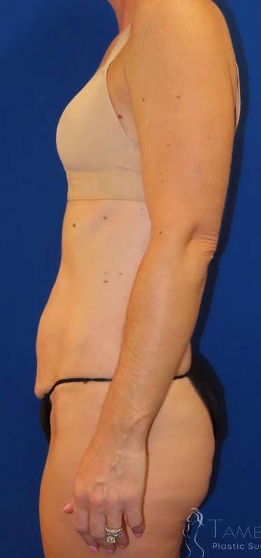 Tummy Tuck Before & After Patient #1236