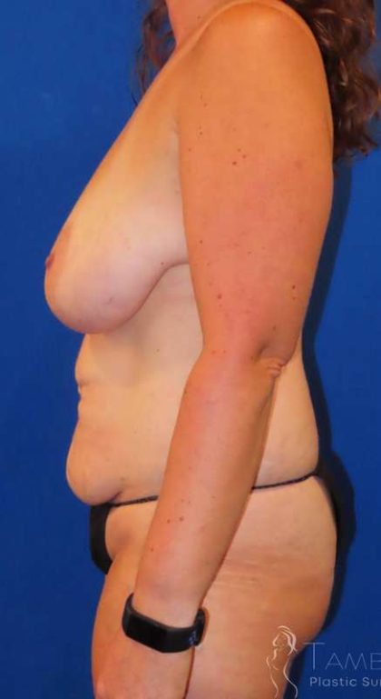 Tummy Tuck Before & After Patient #1260