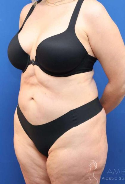 Tummy Tuck Before & After Patient #1356