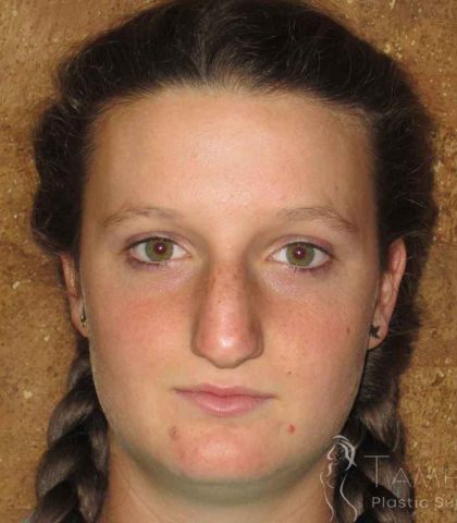 Rhinoplasty Before & After Patient #1406