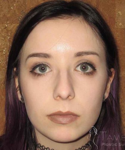 Rhinoplasty Before & After Patient #1439
