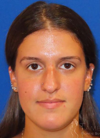 Rhinoplasty Before & After Patient #1454
