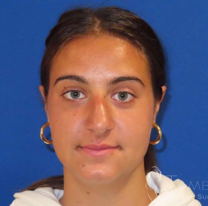 Rhinoplasty Before & After Patient #1465